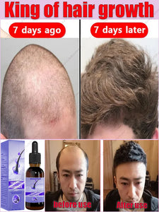 Fast Hair Growth Essence Effective Anti Hair Loss Serum Baldness Repair Hereditary Postpartum Seborrheic Hair Loss   Care