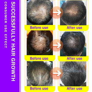 Fast Hair Growth Essence Effective Anti Hair Loss Serum Baldness Repair Hereditary Postpartum Seborrheic Hair Loss   Care